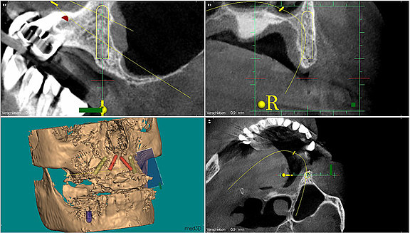 Implantatplanung-mit-dreidimensionalen-CT-Bildern__1_.jpg 