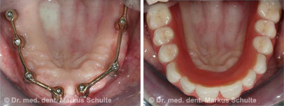 herausnehmbarer-Zahnersatz-Zahnarzt-Luzern.jpg 